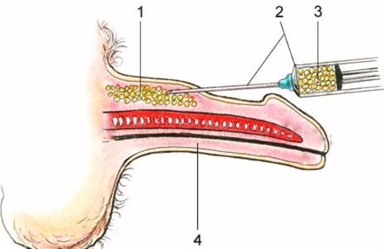 injectare marirea penisului
